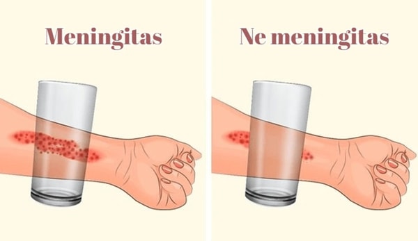 Neišnykstantys odos bėrimai