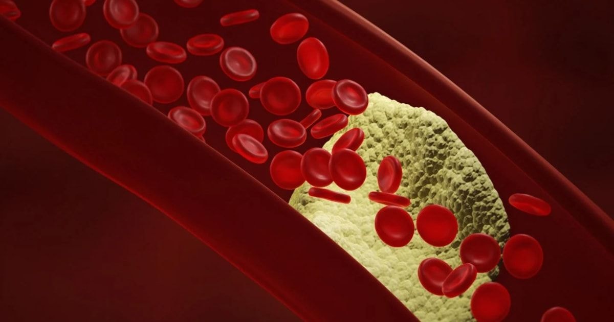 Kardiologai atskleidė, kas veiksmingiau mažina „blogąjį“ cholesterolį nei sveika mityba