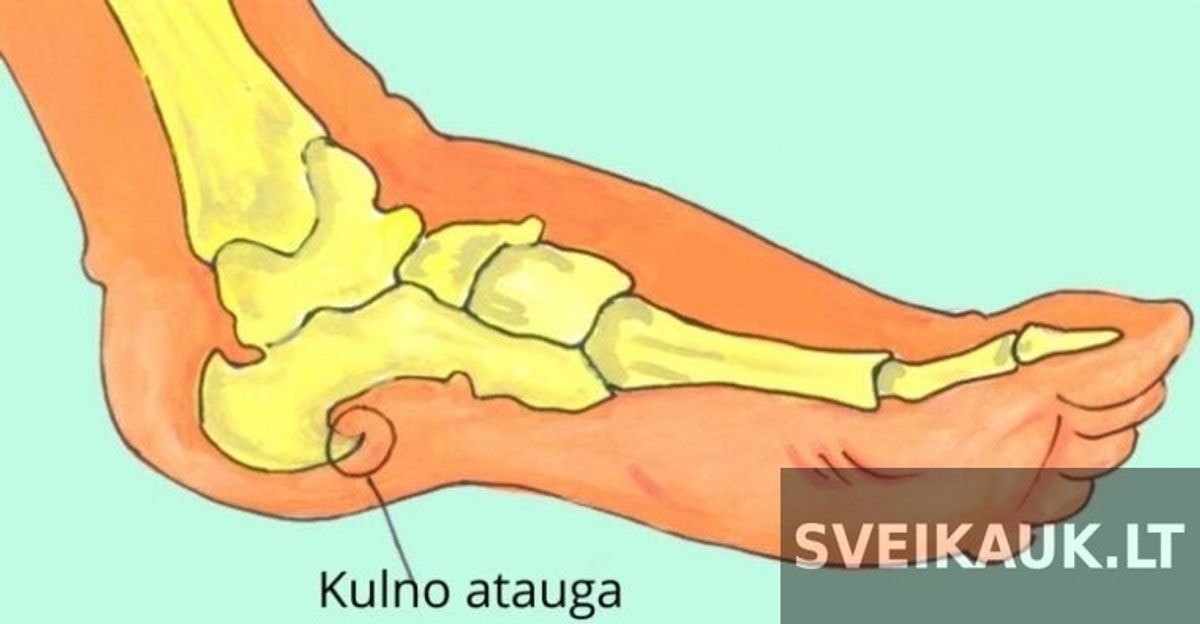 3 veiksmingi būdai atsikratyti kulno ataugų