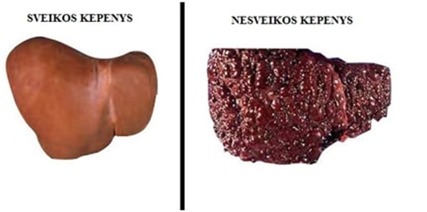 Labai svarbu rūpintis kepenų sveikata