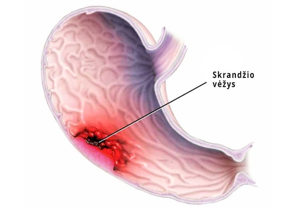 Skrandžio vėžio prevencija