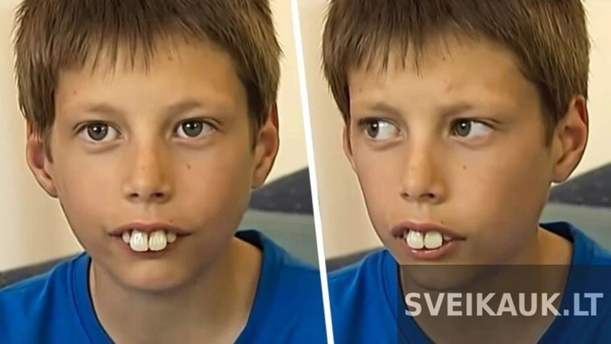 Dėl neįprastai didelių dantų šis berniukas ilgai kentė patyčias. Tačiau po 5 metų jis atrodo kaip kitas žmogus