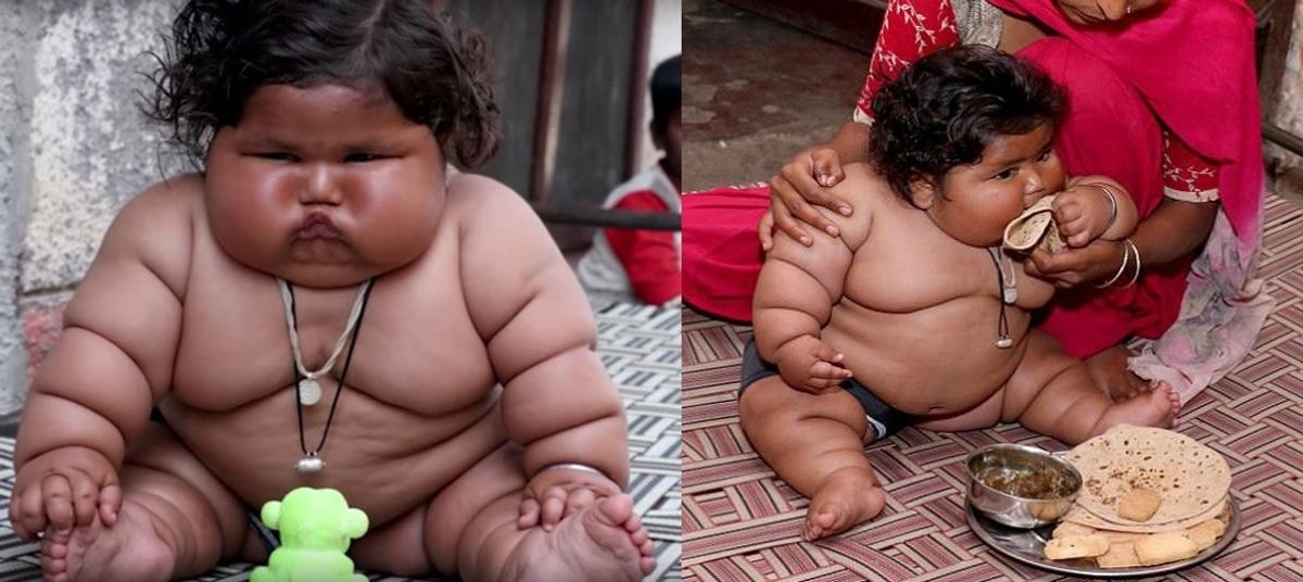 Milžiniška mergaitė Chahat: jai buvo mažiau nei metai, kai ji jau svėrė 20 kg