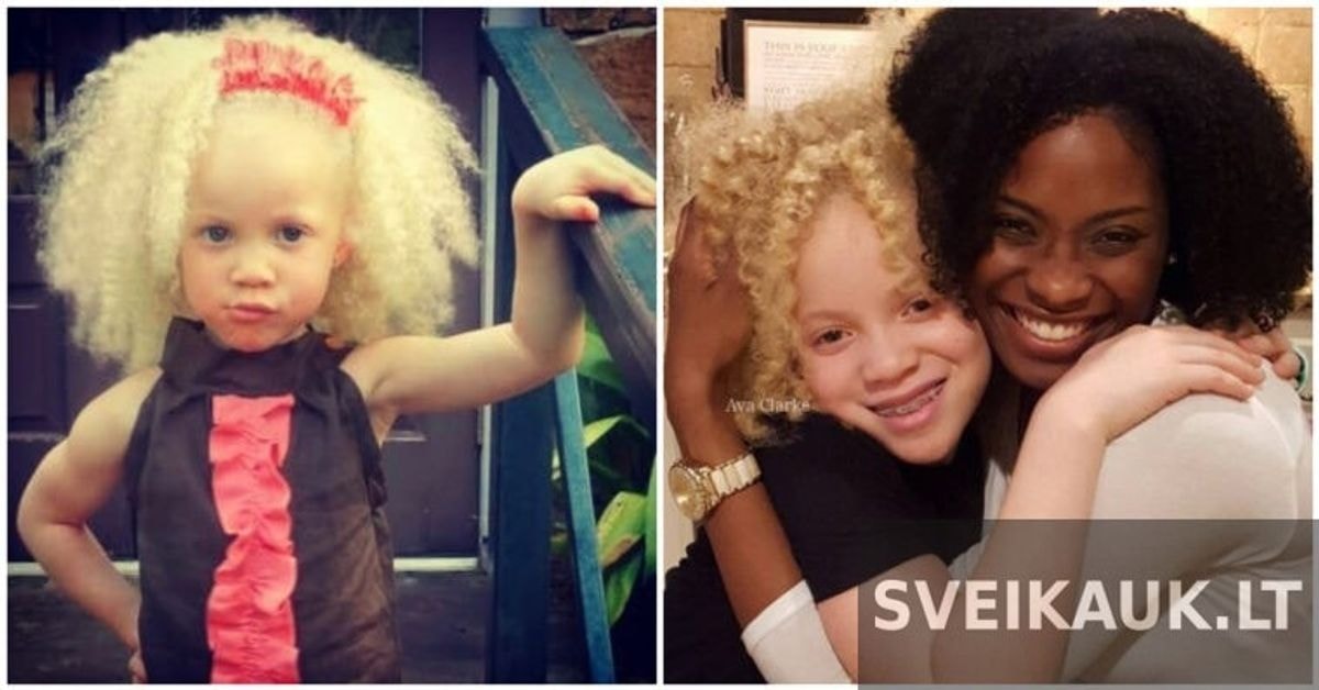 Afrikietė mergaitė albinosė pavertė savo ypatybę privalumu