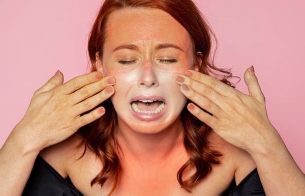 woman with skin burnes face crying 